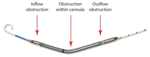 Image showing the areas of obstruction in an Impella heart pump